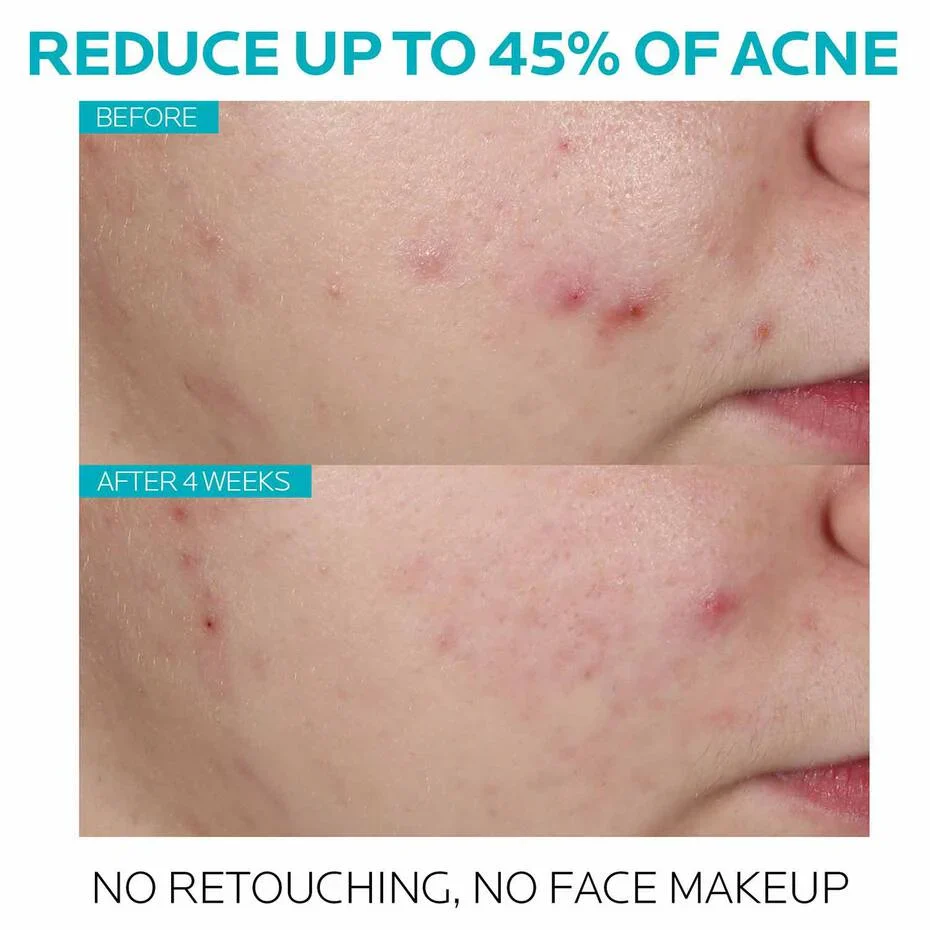 EFFACLAR ACNE TREATMENT LA ROCHE-POSAY 45G