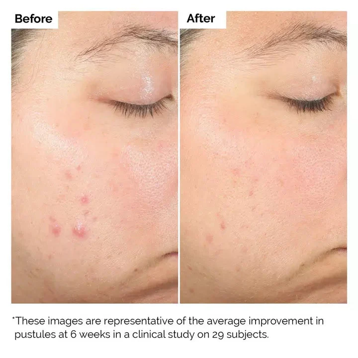 THE ORDINARY  SALICILYC ACID 2% 30ML